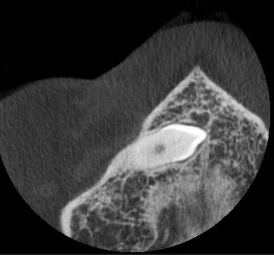 Cone Beam montrant une canine incluse au maxillaire
