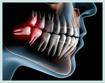 Dents de sagesse